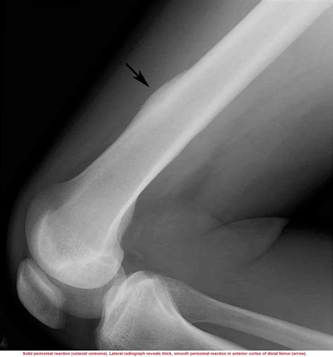 Osteosarcoma X Ray Codmans Triangle