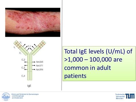 Targeting grossly elevated IgE: a novel therapeutic option in severe