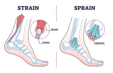 Sprain Vs Strain Anatomical Comparison As Medical Foot Injury Outline ...