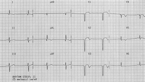 Left Ventricular Aneurysm • LITFL • ECG Library Diagnosis