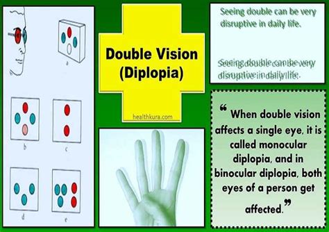 Double Vision (Diplopia): Causes, Tests, and Treatment | Health Kura