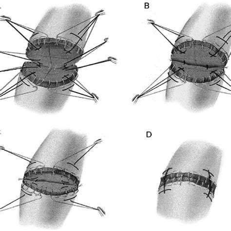 The modified Mason-Allen stitch. The first throw begins through the... | Download Scientific Diagram