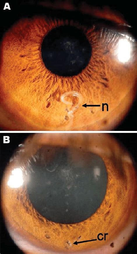 Eye of the patient, a 29-year-old man from Brazil. A) Nematode (n)... | Download Scientific Diagram