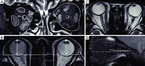 Measurements of orbital MRI data on T2-weighted images. (A ...