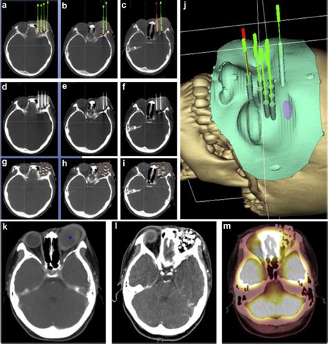 The CT-guided ¹²⁵I seed implantation procedure and therapeutic ...