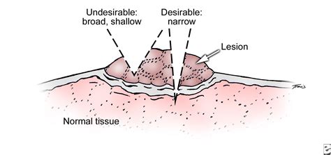 ORAL & MAXILLO-FACIAL SURGERY: Oral Punch Biopsy and Scalpel Biopsy