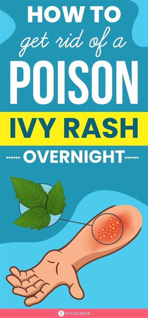 How to get rid of a poison ivy rash overnight – Artofit