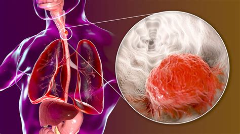 Esophageal Cancer - Arizona Oncology Foundation