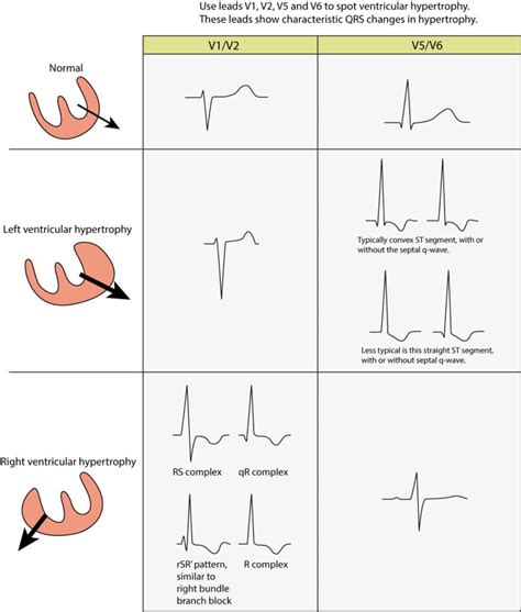 The ECG in left ventricular hypertrophy (LVH): criteria and ...