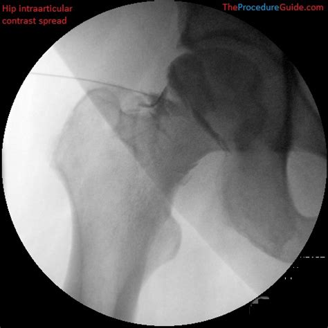 Fluoroscopic Guided Hip Joint Injection - Technique and Overview - The ...