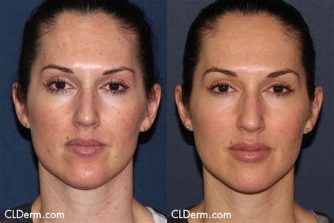 Sciton Profile Laser Skin Treatment | San Diego, CA | CLDerm