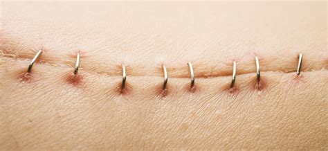 SURGICAL SUTURES- ALL YOUR QUERIES ANSWERED | Add More to Life - Meril