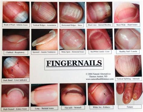 don't know if this is TCM? | Nail health signs, Fingernail health signs ...