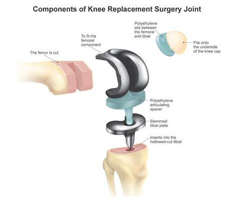 Arthrex iBalance Knee Replacement | Recall & Tibial Loosening