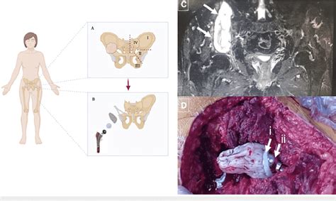 Reconstruction of hemipelvectomy I-II. (A) The right pelvis... | Download Scientific Diagram