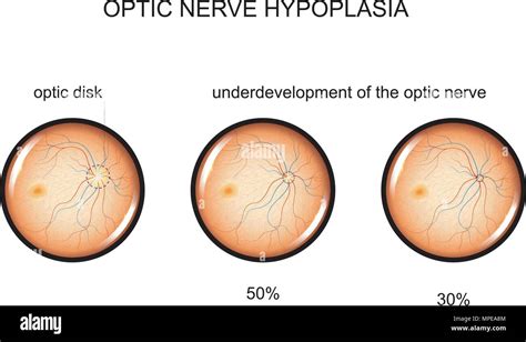 vector illustration of optic nerve hypoplasia. ophthalmology Stock ...