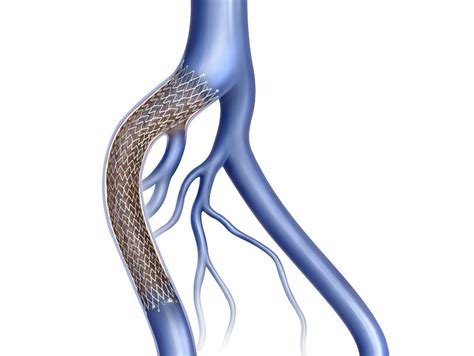 Artery Stents - Vein Stents - Experts in Blood Veseel Stent Procedures