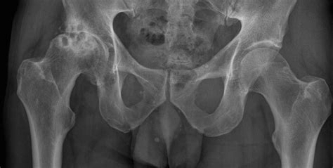 Osteoarthritis – hip - Radiology at St. Vincent's University Hospital