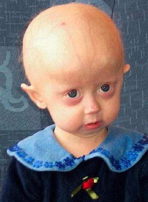 What Is Progeria? | amomentofscience - Indiana Public Media