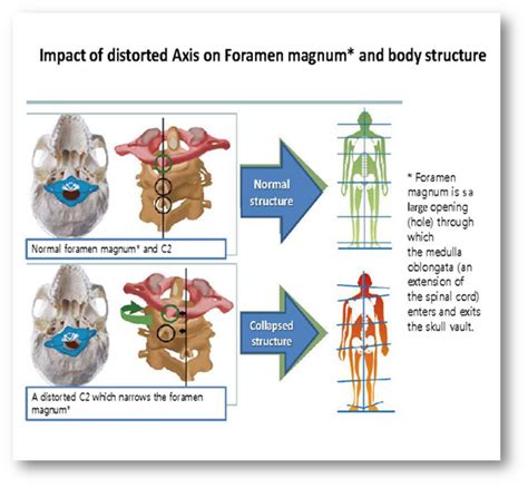 Atlantoaxial Instability