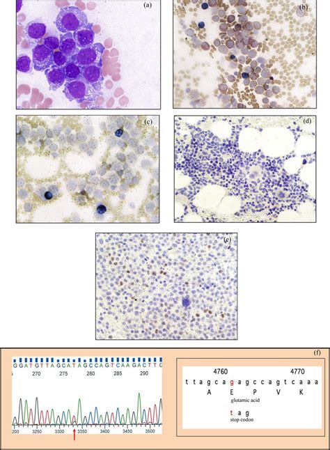 Bone marrow examination. There were 16.0 × 10 4 /μL and 63.0/μL... | Download Scientific Diagram