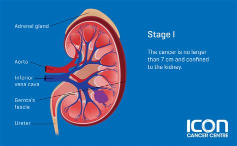 Kidney Cancer — Icon Cancer Centre Singapore