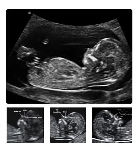 Trisomy 21 (Down Syndrome): Definition, Causes, Symptoms, Pictures and Diagnosis