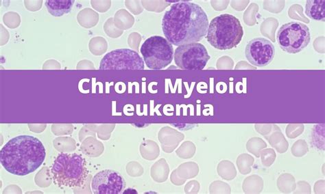 Chronic Myeloid Leukemia (CML) | Medical Junction