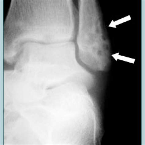 Plane X-ray showing osteolytic lesions on the left lateral malleolus... | Download Scientific ...