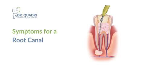 Symptoms for a Root Canal: All About the Root Canal Therapy.