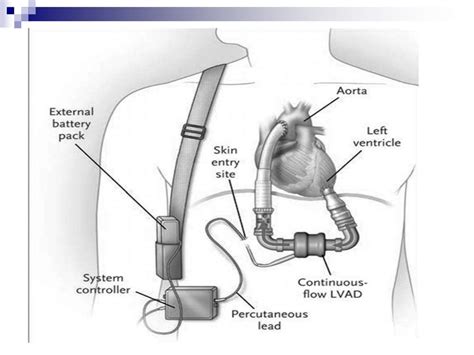 Advanced ventricular assist device ppt