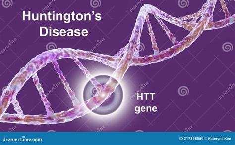 Huntington S Disease, a Neurodegenerative Disease Due To Mutation in the Huntingtin Gene, HTT ...