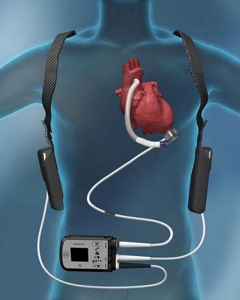 LVAD Surgery | Left Ventricular Assist Device | MedStar Health