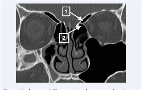 Figure 1 from The “Mesentery” of the Anterior Ethmoid Artery | Semantic ...