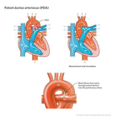 Cardiology : Patent Ductus Arteriosus PDA