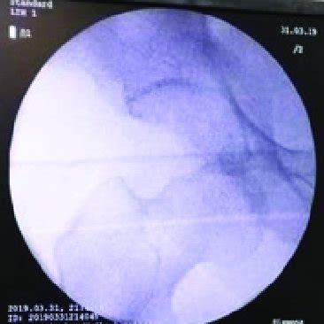 Radiographic image showing the right anterior dislocation of hip ...