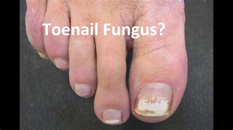 White Toe Fungus