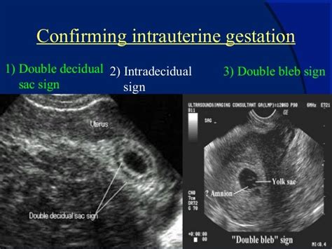 Early pregnancy ultrasonographic evaluation