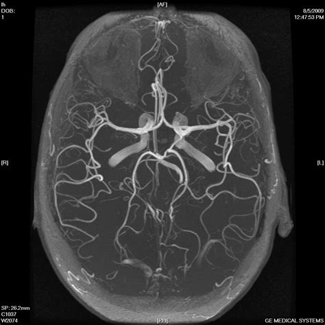 blood vessels inside brain, as seen via MRI. Anatomy Art, Human Anatomy ...