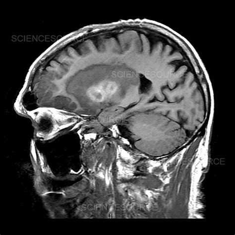 Hemorrhagic Stroke, MRI | Stock Image - Science Source Images