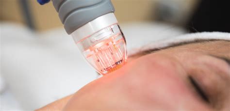 Scarlet RF Microneedling - Advanced Dermatology Care