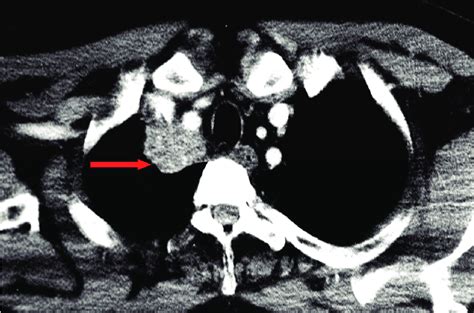 Pancoast tumor located in the anterior component (anterior Pancoast tumor). | Download ...