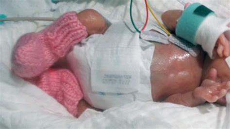 'World's smallest baby' thriving after premature birth | Fox News