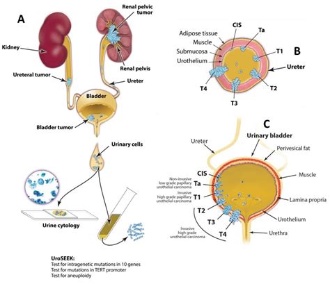 Non-invasive detection of urothelial cancer through the analysis of driver gene mutations and ...