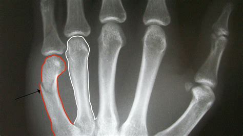 Musculoskeletal (MSK) X-ray Interpretation - OSCE Guide | Geeky Medics