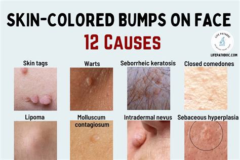 Skin Colored Bumps on Face: 12 Causes, Pictures & Treatment