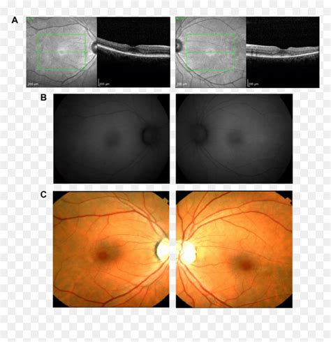 Bull"s Eye Maculopathy Visible On Near-infrared Reflectance - Bull's Eye Maculopathy Hcq, HD Png ...