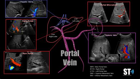 Portal Vein Doppler – Sonographic Tendencies