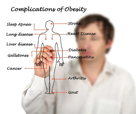 Diagram of Complications of Obesity Stock Photo by ©vaeenma 122767446