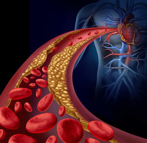 The Diabetes-heart Disease Connection - This Quarterly